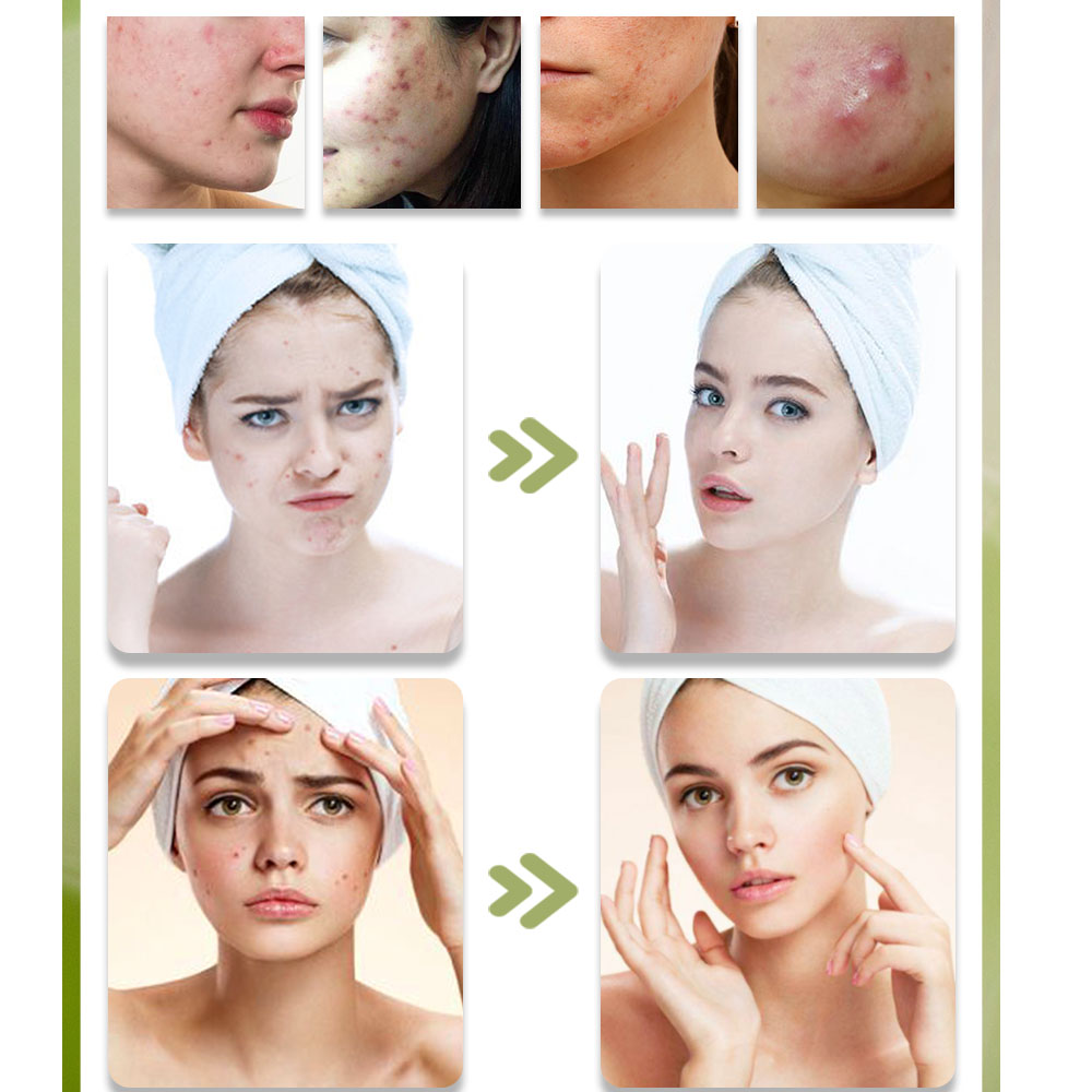 KStims doğal akne tedavisi Ant - Tea Tree Spot Treatment incelemesi ve fiyatı